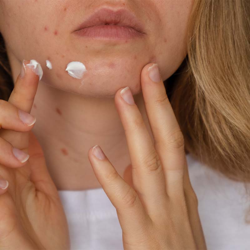 mulher com cicatrizes e marcas de acne