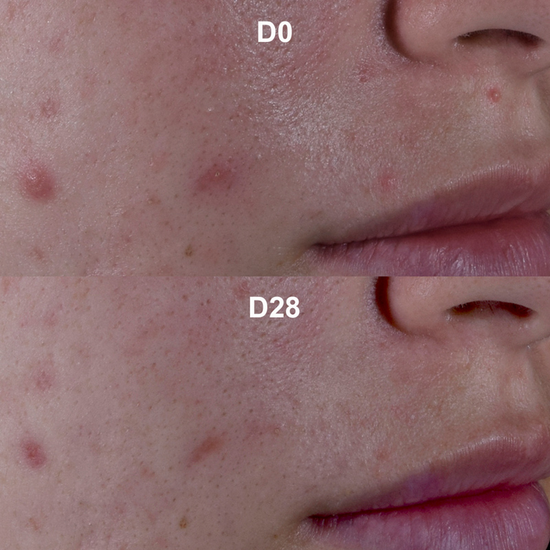 Antes e depois do Sébium Kerato+