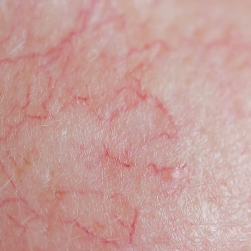 Pele com vasos visíveis