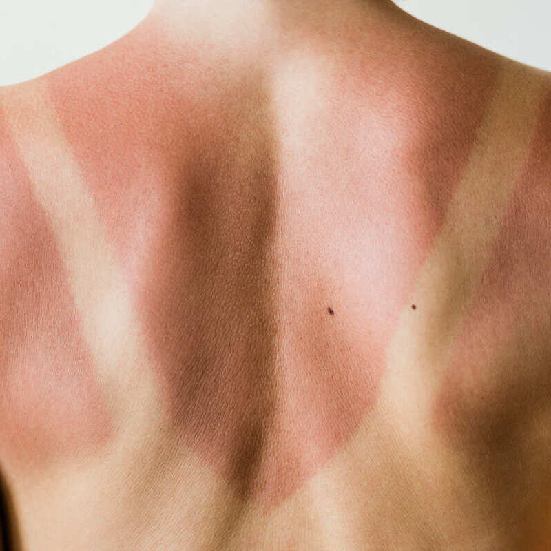 Costas queimadas de sol