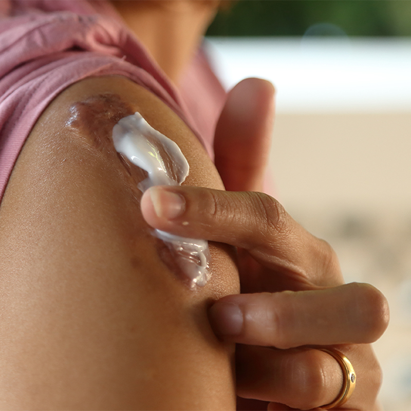 Pessoa a aplicar creme em uma cicatriz no ombro