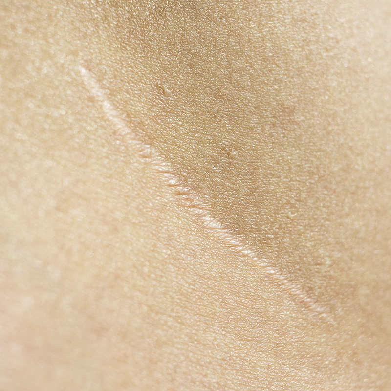 Closeup de cicatriz na pele