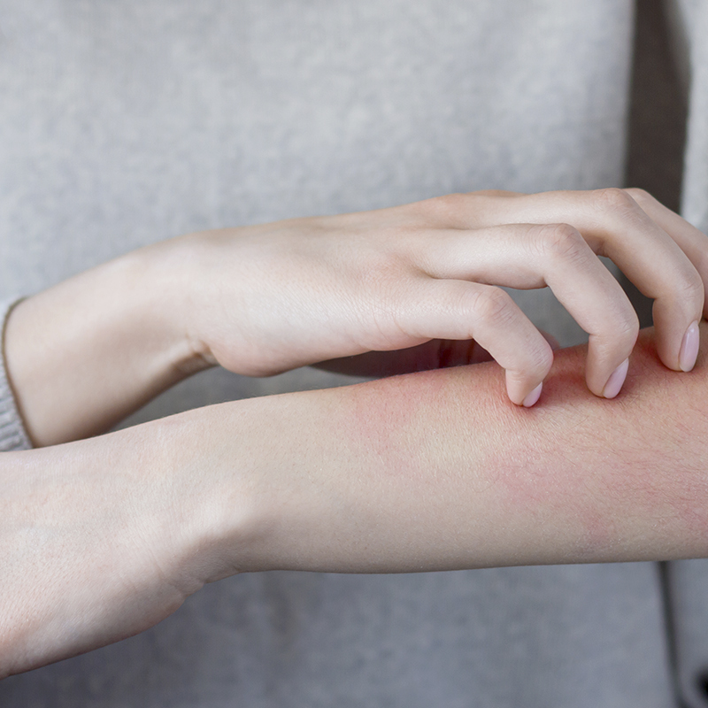 Pessoa com prurido no braço