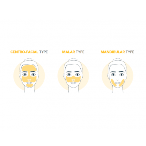 Imagem de tipos de melasma