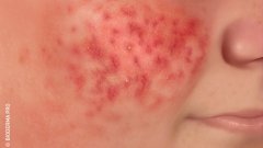 Pele com vermelhidão