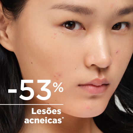 Reduz lesões acneicas