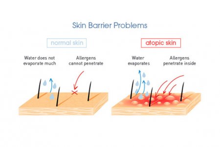Schema Skin Barrier Problem
