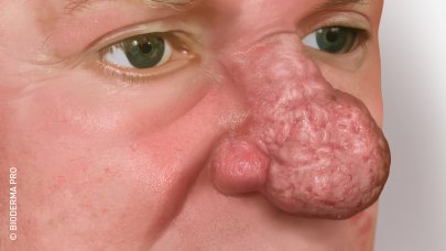 Thickening of the skin with a bulbous nose, which represents the most severe phase of rosacea