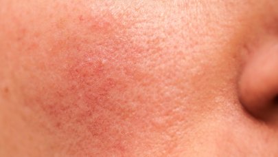 Light redness on the face, first signs of rosacea.